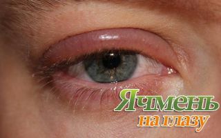 Причины появления и лечение ячменя на глазу